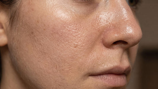 Greasy Yet Flaking? Why Your Oily Skin Is Actually Begging for Water